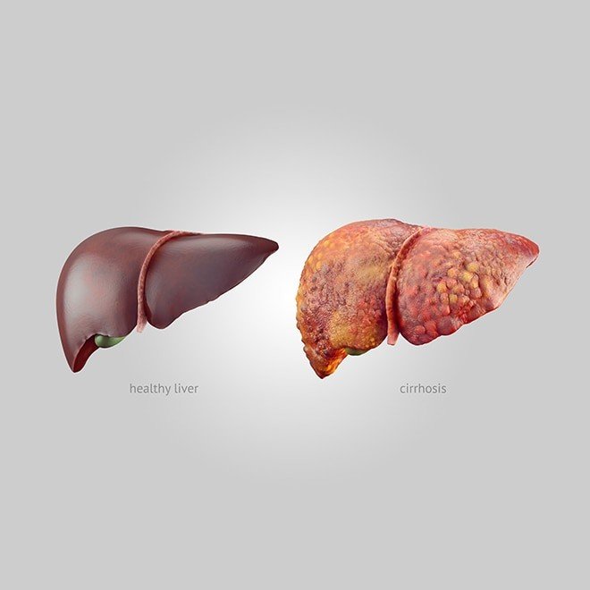 Managing Cirrhosis
