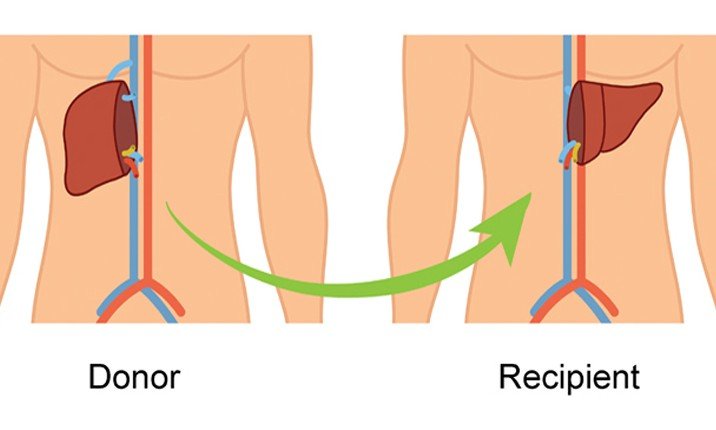 Types of Liver Transplant