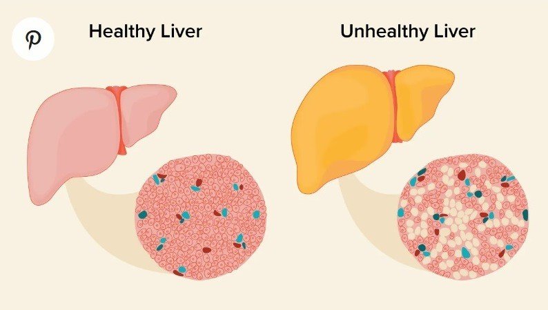 Fatty Liver Disease