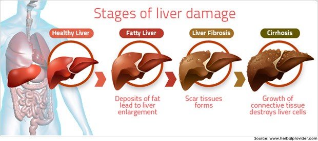 Fatty Liver Stages